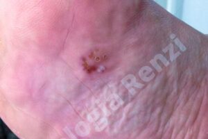 tinea-pedis-podologia-renzi-3